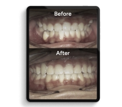 Before treatment and after treatment image